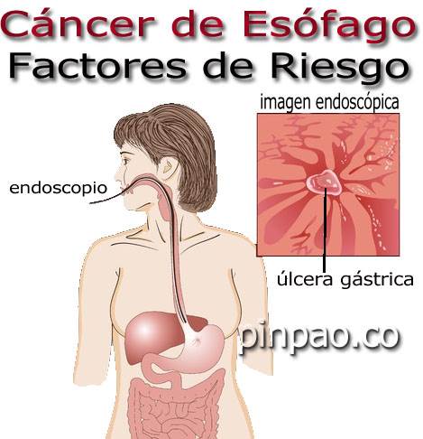cancer de esofago