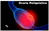 ovario poliquistico